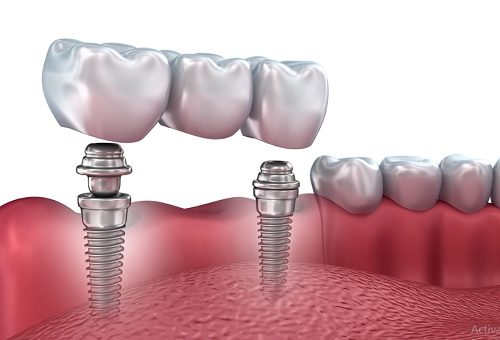 mini dental implant care